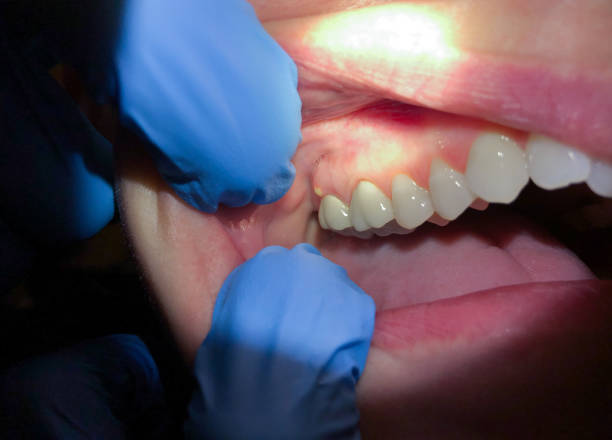 Best Dental Abscess Treatment in Fullerton, PA